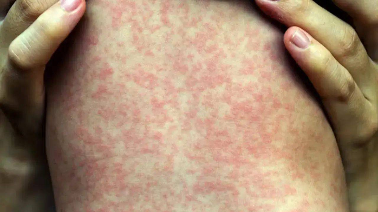 ছবিঃ হাম ভাইরাস , CBC