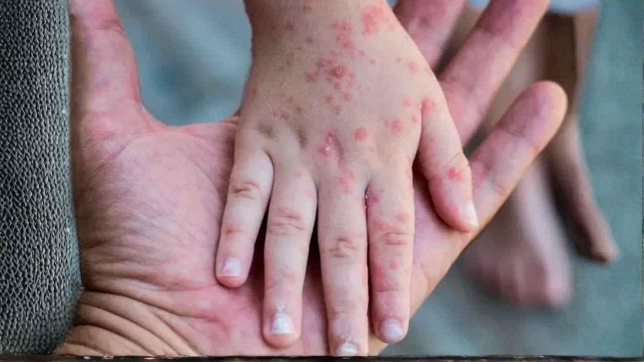 হাম নিয়ে যে ভুল ধারণাগুলো আপনার শিশুর জীবন ঝুঁকির মুখে ফেলছে